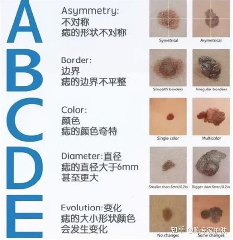 痣的顏色|4個簡易方法 教你辨別好痣壞痣